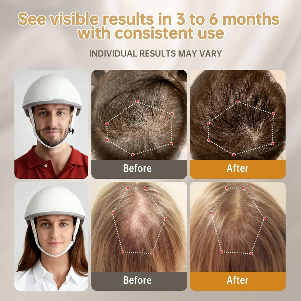 Red Light Therapy for Hair Growth thumbnail